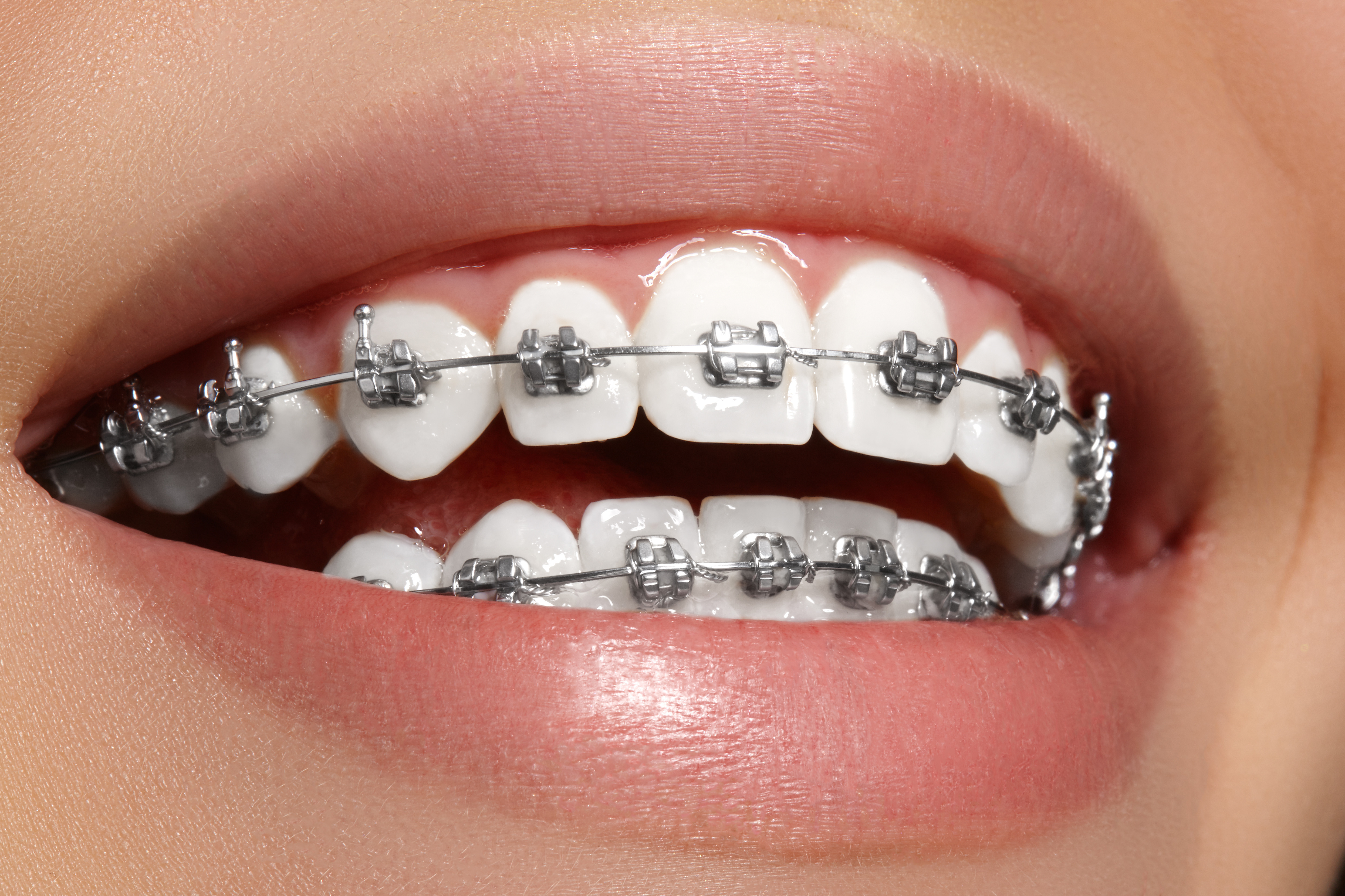 Behel Metal Nine Dental